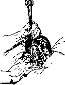 Hysterectomy: figure 1 from the 1928–1936 encyclopedia article