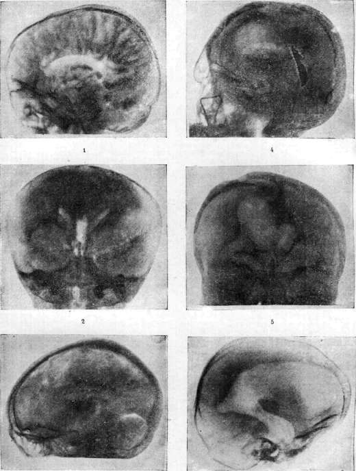 Encephalography: figure 1 from the 1928–1936 encyclopedia article