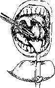 Tonsil Pharyngeal: figure 2 from the 1928–1936 encyclopedia article
