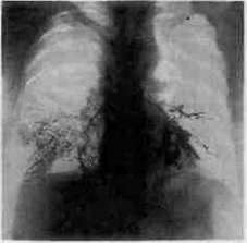 Broncholiths and Bronchomycoses: figure 4 from the 1928–1936 encyclopedia article