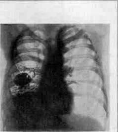 Broncholiths and Bronchomycoses: figure 2 from the 1928–1936 encyclopedia article