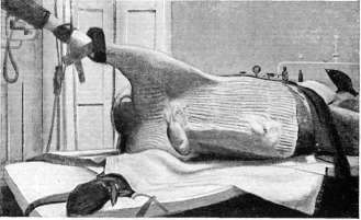 Smallpox Detritus: figure 3 from the 1928–1936 encyclopedia article
