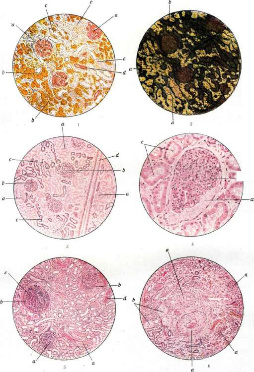 Nephritis: figure 1 from the 1928–1936 encyclopedia article