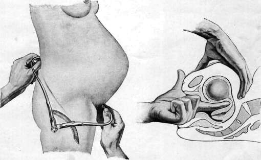 Obstetric Manual Maneuvers: figure 2 from the 1928–1936 encyclopedia article