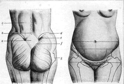 Obstetric Manual Maneuvers: figure 1 from the 1928–1936 encyclopedia article