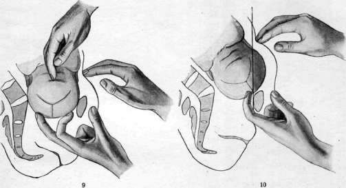 Obstetric Manual Maneuvers: figure 6 from the 1928–1936 encyclopedia article
