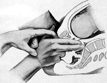 Obstetric Manual Maneuvers: figure 7 from the 1928–1936 encyclopedia article