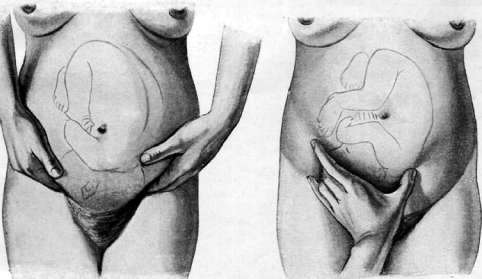 Obstetric Manual Maneuvers: figure 5 from the 1928–1936 encyclopedia article