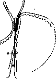 Cardiospasm: figure 3 from the 1928–1936 encyclopedia article