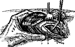 Castration: figure 1 from the 1928–1936 encyclopedia article