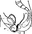 Uterine Prolapse: figure 2 from the 1928–1936 encyclopedia article