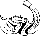 Uterine Prolapse: figure 5 from the 1928–1936 encyclopedia article