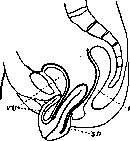 Uterine Prolapse: figure 1 from the 1928–1936 encyclopedia article