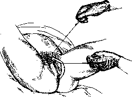 Pelveoperitonitis: figure 13 from the 1928–1936 encyclopedia article