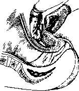 Pelveoperitonitis: figure 9 from the 1928–1936 encyclopedia article