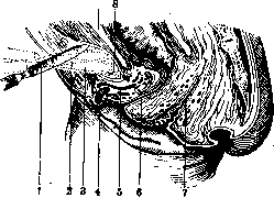 Pelveoperitonitis: figure 6 from the 1928–1936 encyclopedia article