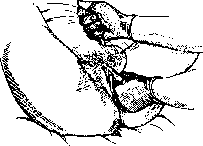 Pelveoperitonitis: figure 10 from the 1928–1936 encyclopedia article