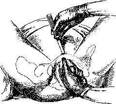 Pelveoperitonitis: figure 1 from the 1928–1936 encyclopedia article