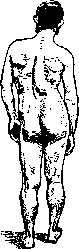 Sciatica: figure 1 from the 1928–1936 encyclopedia article