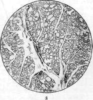 Goiter: figure 8 from the 1928–1936 encyclopedia article