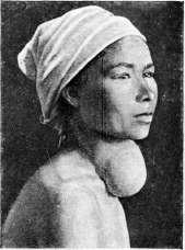 Goiter: figure 7 from the 1928–1936 encyclopedia article