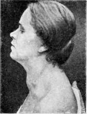 Goiter: figure 1 from the 1928–1936 encyclopedia article