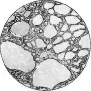 Goiter: figure 4 from the 1928–1936 encyclopedia article
