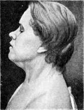 Goiter: figure 2 from the 1928–1936 encyclopedia article