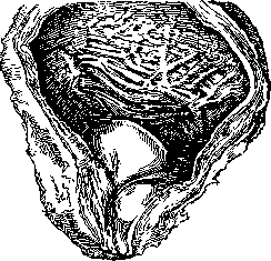 Hypertrophy: figure 3 from the 1928–1936 encyclopedia article