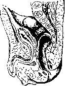 Rectal Prolapse: figure 2 from the 1928–1936 encyclopedia article