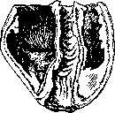 Rectal Prolapse: figure 5 from the 1928–1936 encyclopedia article