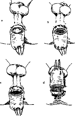 Rectal Prolapse: figure 11 from the 1928–1936 encyclopedia article