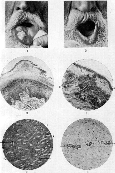 Leukoplakia: figure 1 from the 1928–1936 encyclopedia article