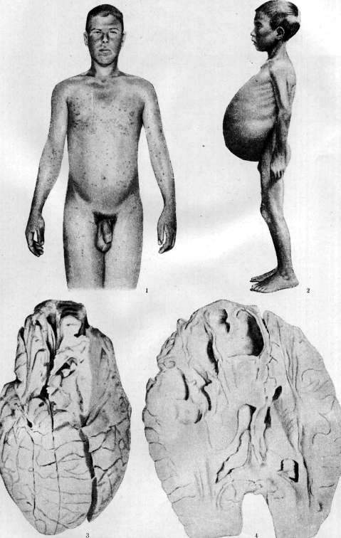 Malaria: figure 24 from the 1928–1936 encyclopedia article