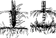 Intestinal Suture: figure 9 from the 1928–1936 encyclopedia article