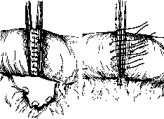 Intestinal Suture: figure 7 from the 1928–1936 encyclopedia article