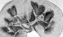 Nephropathy: figure 2 from the 1928–1936 encyclopedia article