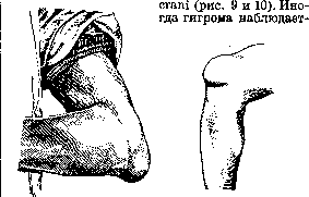 Mucous Bursa: figure 8 from the 1928–1936 encyclopedia article
