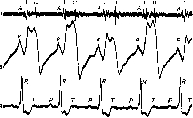 Bisystole: figure 1 from the 1928–1936 encyclopedia article