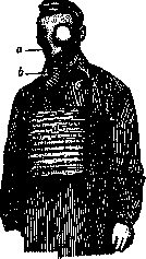 Horner's Syndrome: figure 2 from the 1928–1936 encyclopedia article