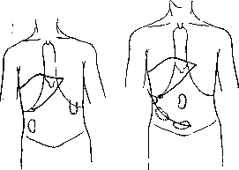 SPLANCHNOMEGALY: figure 5 from the 1928–1936 encyclopedia article