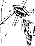 Pirogov's Incision: figure 1 from the 1928–1936 encyclopedia article