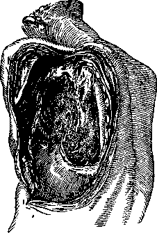 Bronchial Fistulas: figure 1 from the 1928–1936 encyclopedia article