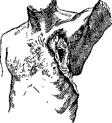 Bronchial Fistulas: figure 2 from the 1928–1936 encyclopedia article