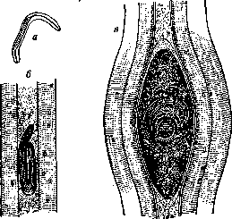 Trichinellosis: figure 2 from the 1928–1936 encyclopedia article