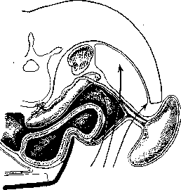 Splenectomy: figure 2 from the 1928–1936 encyclopedia article