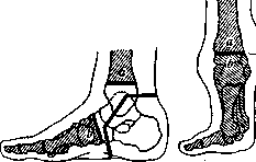 Vladimirova-Mikulicz Operation: figure 2 from the 1928–1936 encyclopedia article