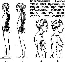 Kyphosis (or round): figure 1 from the 1928–1936 encyclopedia article