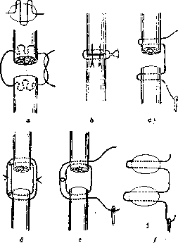 Tendon Suture: figure 1 from the 1928–1936 encyclopedia article