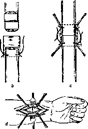 Tendon Suture: figure 3 from the 1928–1936 encyclopedia article